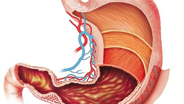 胃溃疡怎么调理？