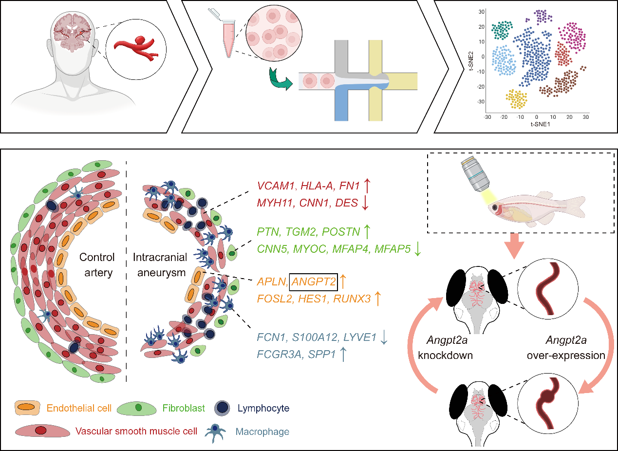 ANGPT2在颅内动脉瘤形成中的关键作用：单细胞分析揭示的分子机制与新型动物模型研究